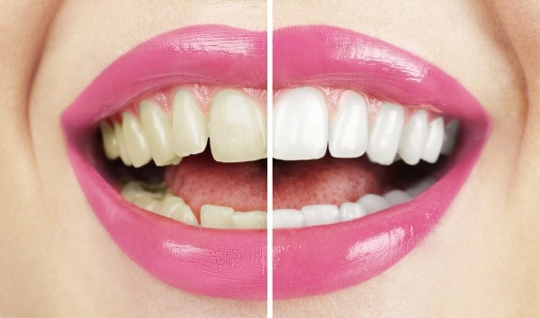 What Makes Ultima White Teeth Whitening Different Bracknell