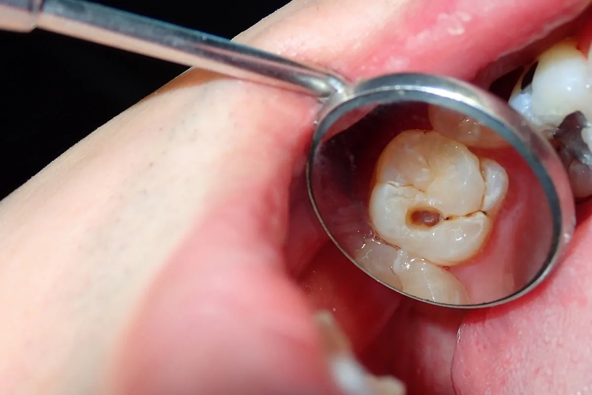 Why Do Teeth Crack? Common Causes to Know Bracknell