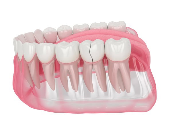 How Can You Manage Pain and Discomfort After a Root Canal Bracknell?